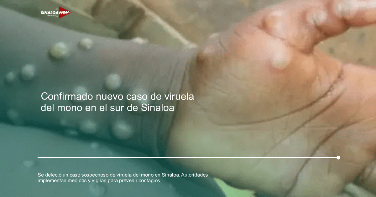 . Sinaloa, Prevención de enfermedades, salud pública, Vigilancia epidemiológica, viruela del mono