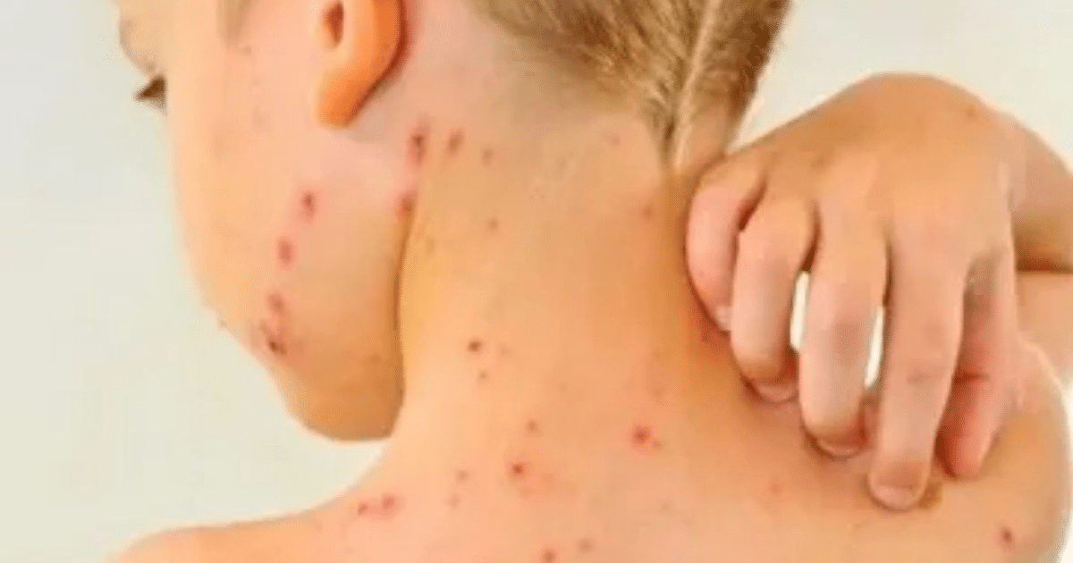 Mapa de Texas mostrando la distribución de casos de sarampión, con énfasis en el condado de Gaines.