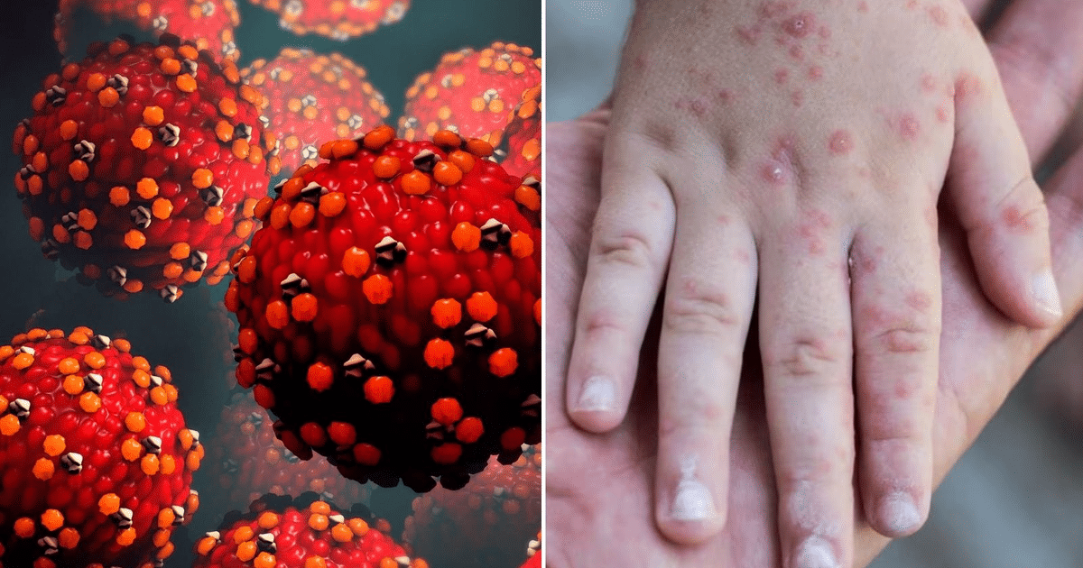 Partículas virales y mano con erupciones cutáneas, relacionadas con sarampión y rubéola en México.