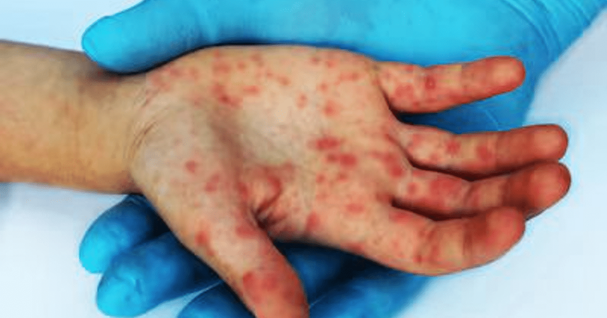 Mano con erupciones cutáneas y guante de látex azul, posible indicio de virus coxsackie.