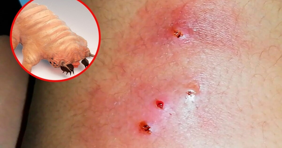 Piel irritada con tardígrado, posible relación con miasis cutánea