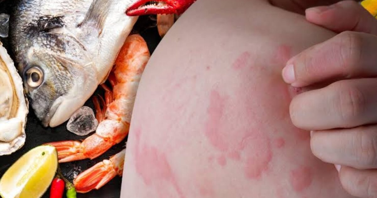Mano rascando piel enrojecida junto a mariscos, sugiriendo alergia alimentaria.