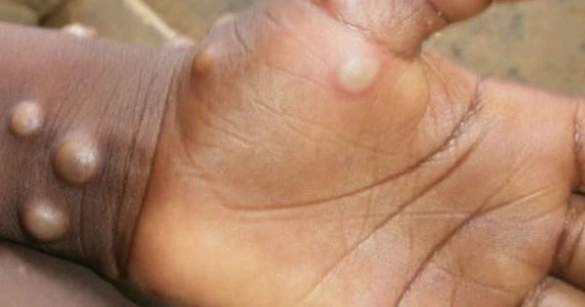 Mano con protuberancias cutáneas claras sobre piel oscura, relacionadas con viruela símica.