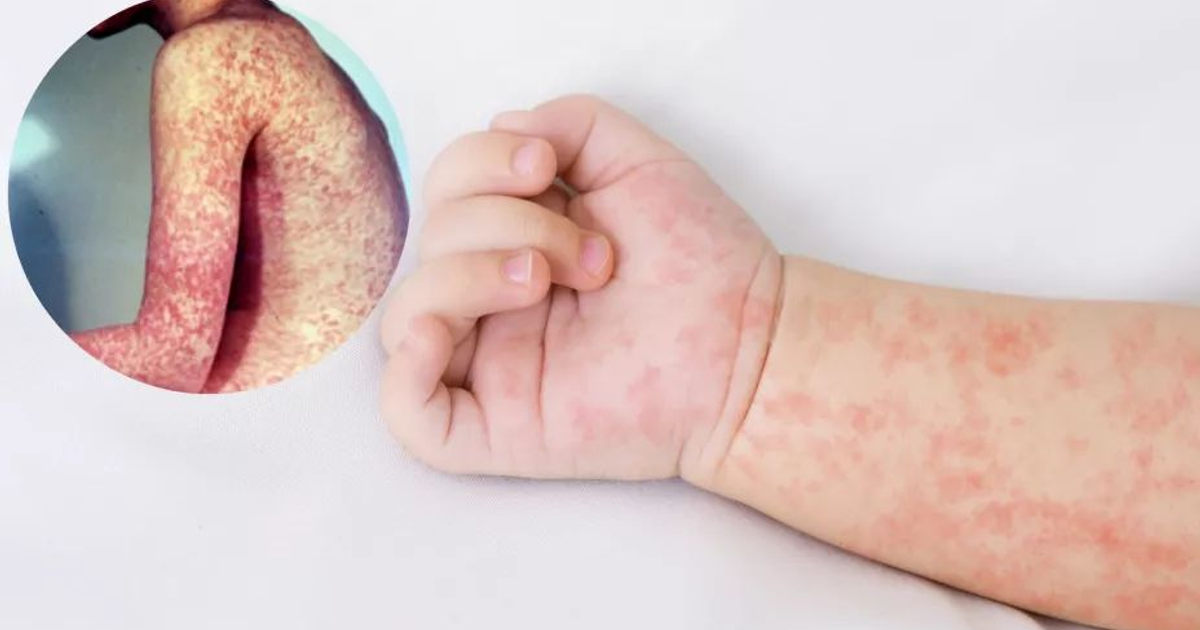 Mano de bebé con erupción cutánea, posible sarampión en Sinaloa