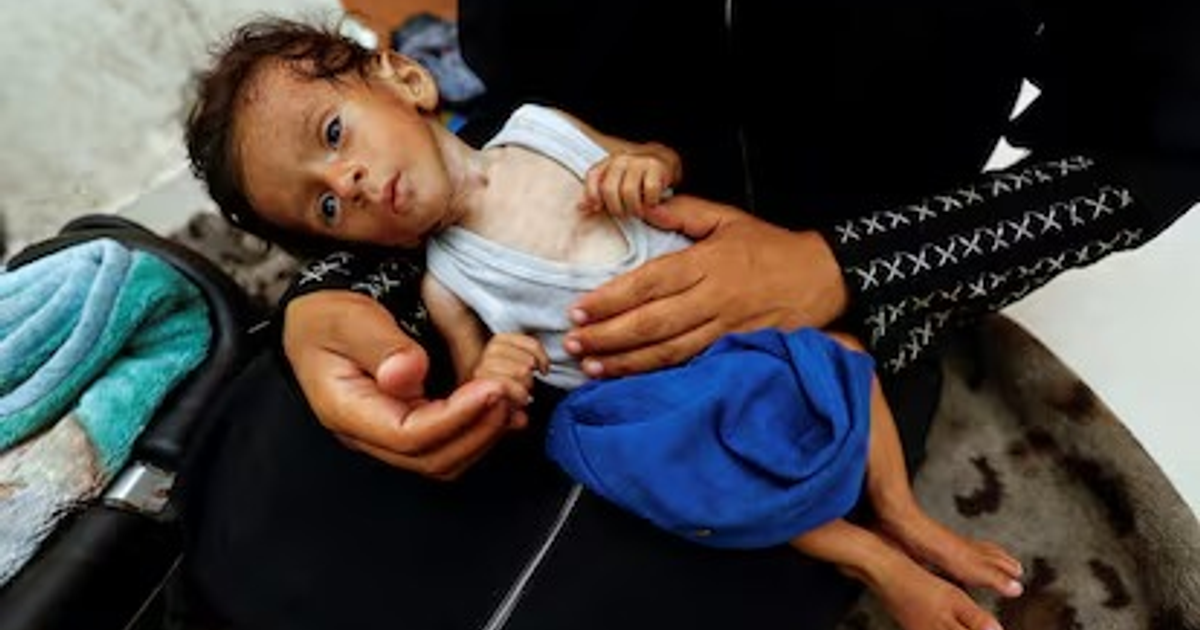 Bebé desnutrido en brazos de un adulto en Gaza, reflejando la crisis alimentaria.