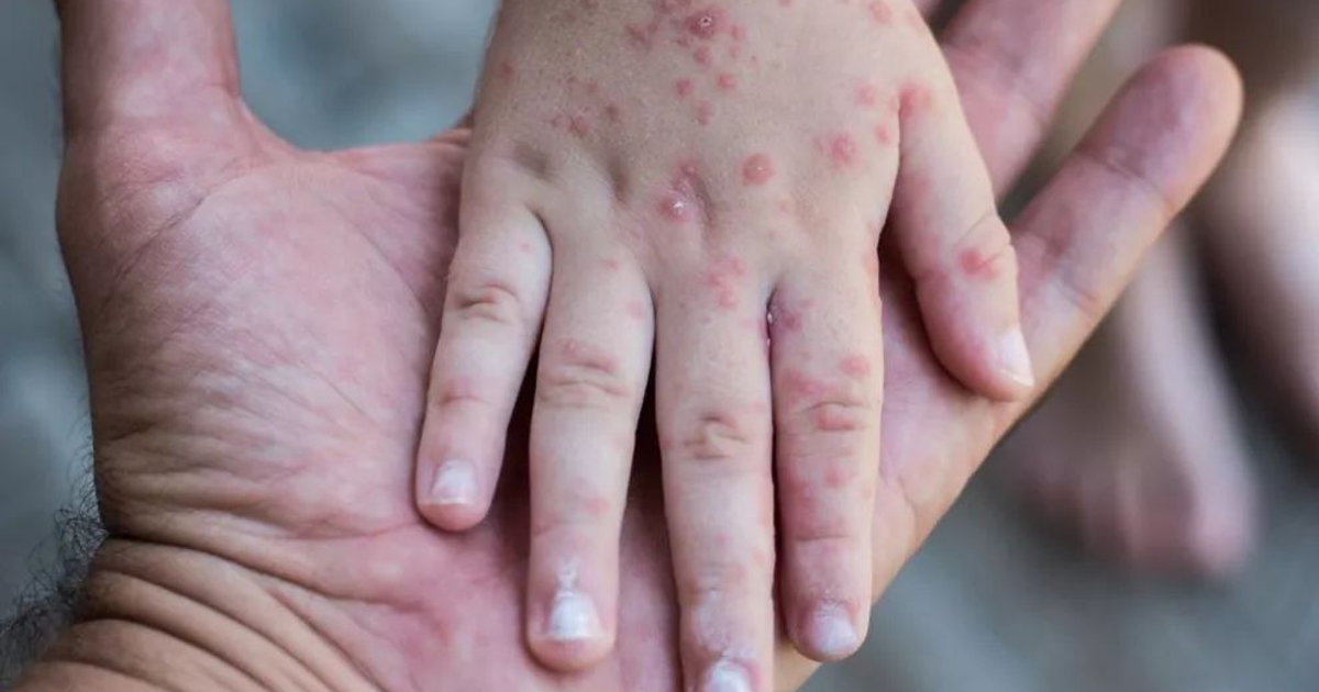 Mano infantil con erupciones de coxsackie sostenida por mano adulta