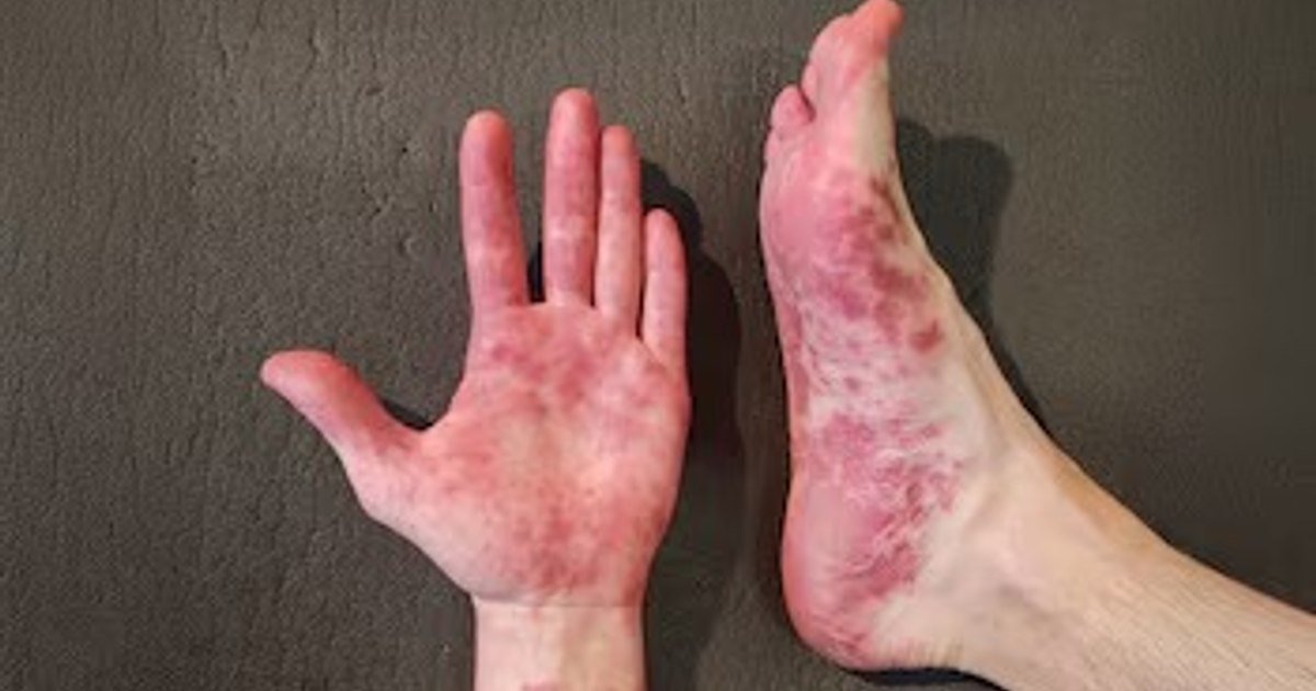 Imagen de mano y pie con enrojecimiento, síntomas del síndrome manos, pies y boca.