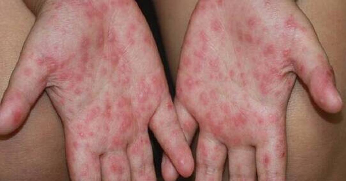 Manos con manchas rojas, posible infección viral relacionada con brote de coxsackie en Guasave.