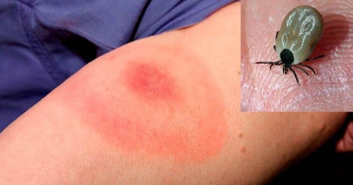 Erupción en brazo humano sugiere posible picadura de garrapata relacionada con rickettsiosis en Sinaloa.