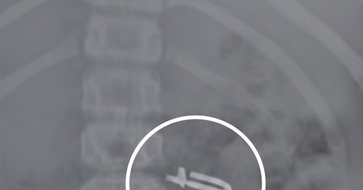 Radiografía mostrando un candadito en el estómago de una niña